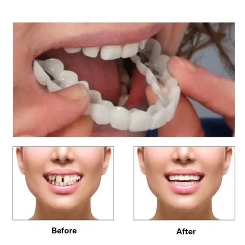 Snap veneers gefälschte - snap,