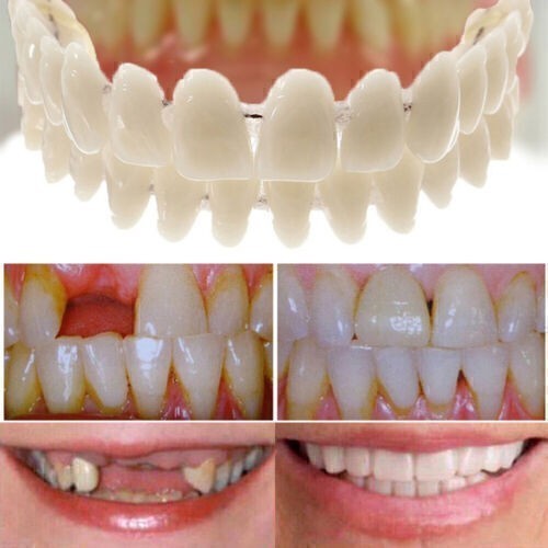 Snap veneers kosmetische - snap,