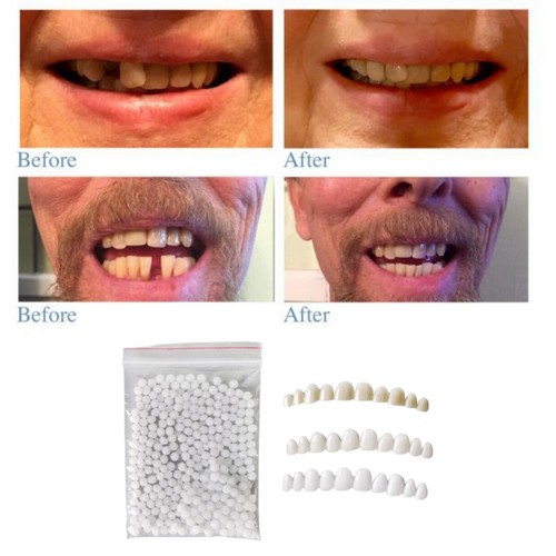 Prothesenzähne veneers mit - prothesenzähne,